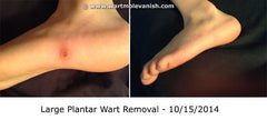 Plantar Wart Removal with Wart & Mole Vanish.  These usually take a couple treatments.