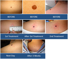 Skin Tag on back - Chely used Wart & Mole Vanish to remove a large skin tag on the back of her neck / back.