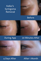 Syringoma removal - Keiko removed many clustered syringoma under her eyes.