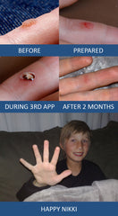 Finger wart gone with Wart & Mole Vanish.  Took 2 back to back treatements.