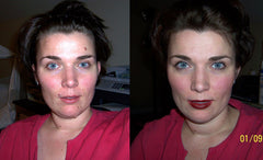 Moles on Face - Rachel used Wart & Mole Vanish to naturally remove the moles on her face